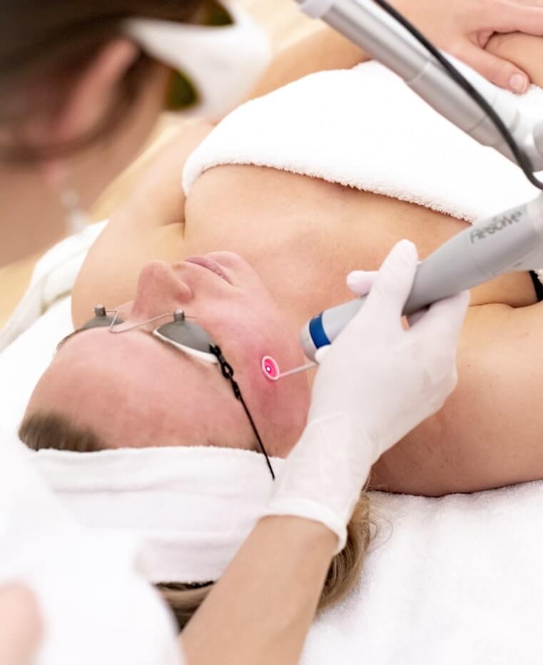 Melasma verwijderen picoway resolve 1