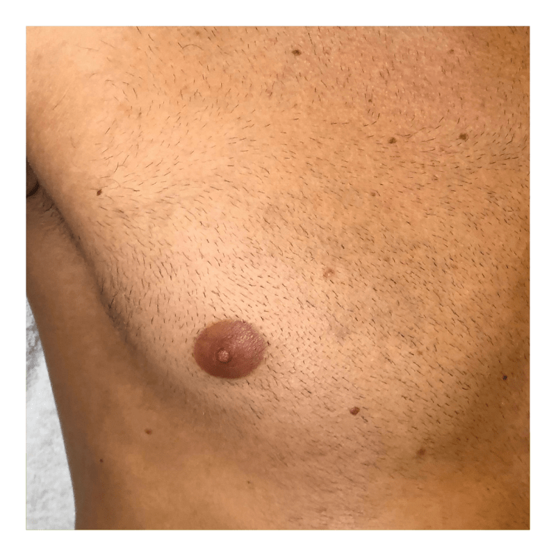 tatoeage verwijderen amsterdam borst after