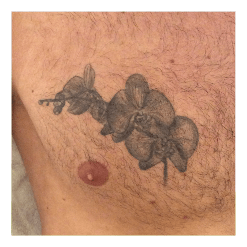 tatoeage verwijderen amsterdam borst before