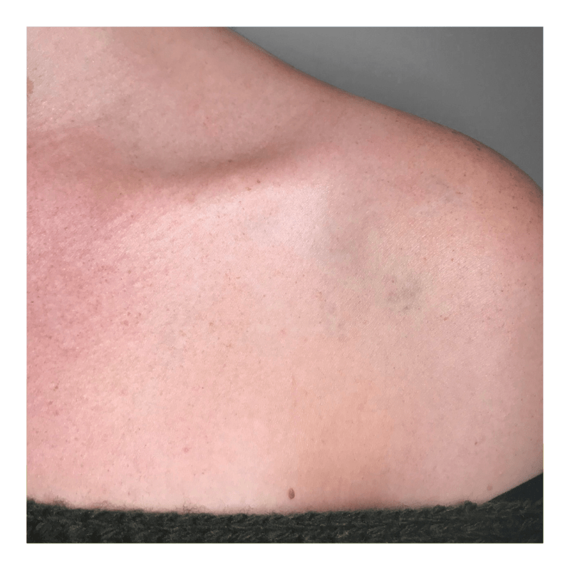 tattoo laseren amsterdam schouder after