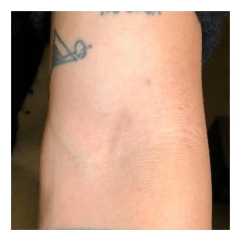 tatoeage laseren amsterdam pols after