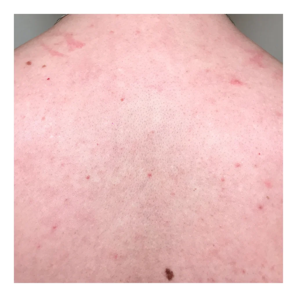 tattoo verwijderen amsterdam rug after