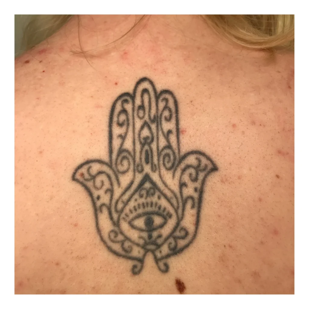 tattoo verwijderen amsterdam rug before